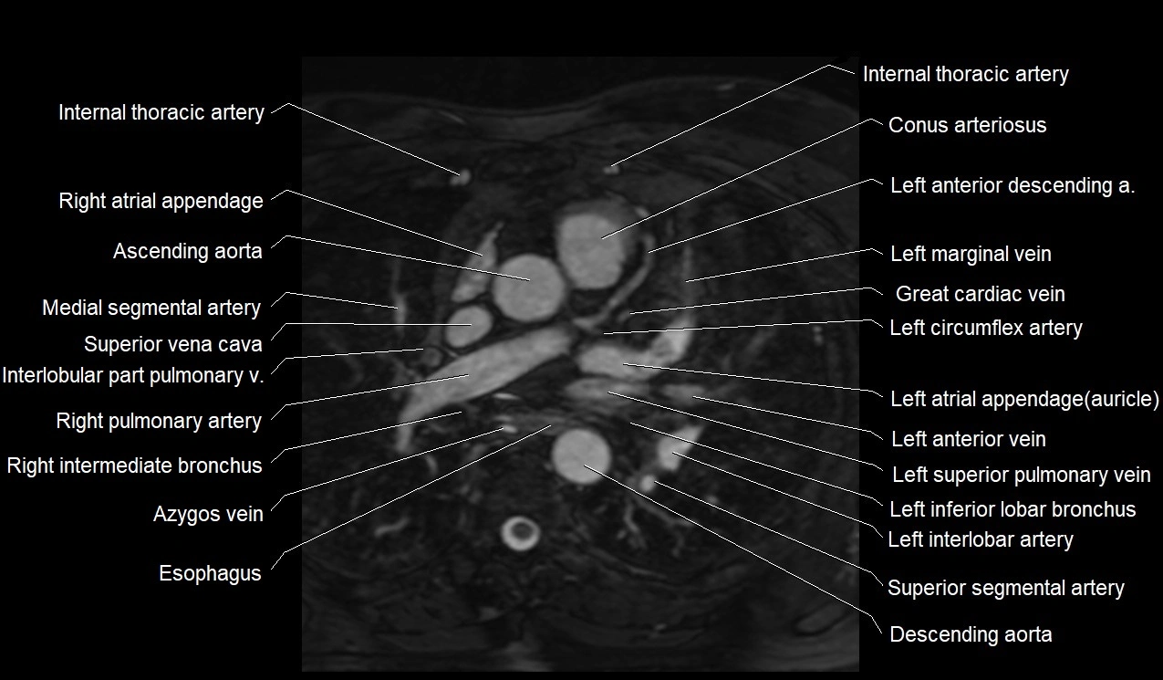 MRI heart coronary arteries and coronary veins anatomy axial image 11.webp